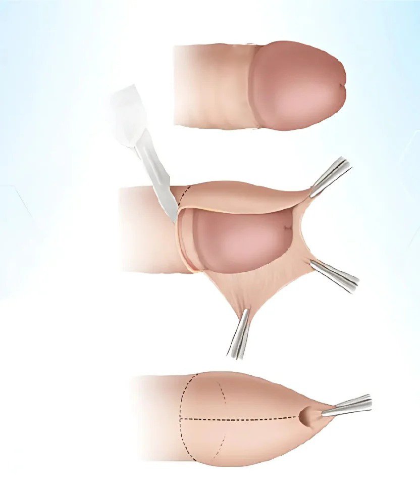 Foreskin Treatment in Delhi